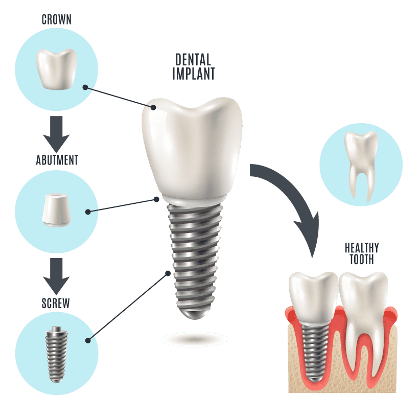 Three stages of a dental implant restoration